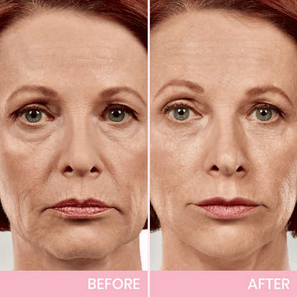 InvisiLift | Invisible Adhesive Tape for Facial Lifting